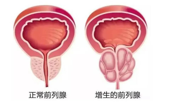 【男性健康日】关注男性健康，护好男性“生命腺”！(图1)