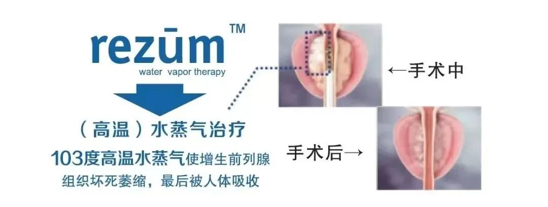 四川结石病医院召开瑞梦前列腺热蒸汽消融手术完成100例学术报告会(图19)