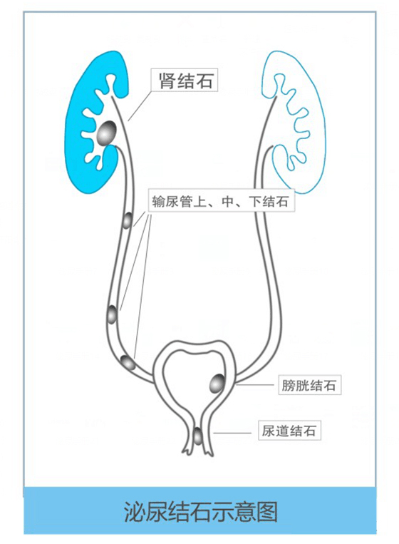 夏季泌尿结石高发，四川结石病医院专家支招这样做……(图1)