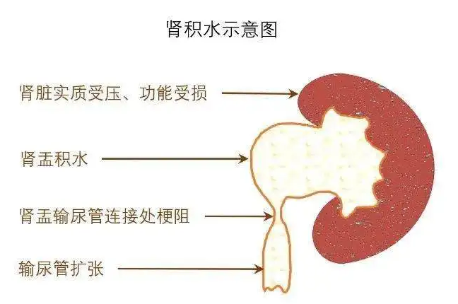 成都肾结石专科医院科普：肾结石是如何导致你的肾脏走向萎缩的？(图2)