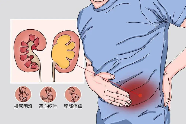 四川碎石医院案例分享：独肾患者碎石不成反复受折磨，四川结石病医院成功保肾取石(图1)