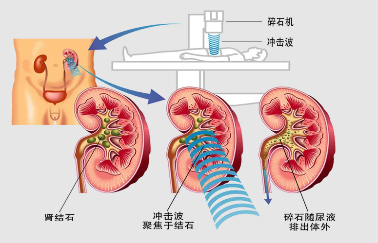 四川碎石医院案例分享：独肾患者碎石不成反复受折磨，四川结石病医院成功保肾取石(图2)