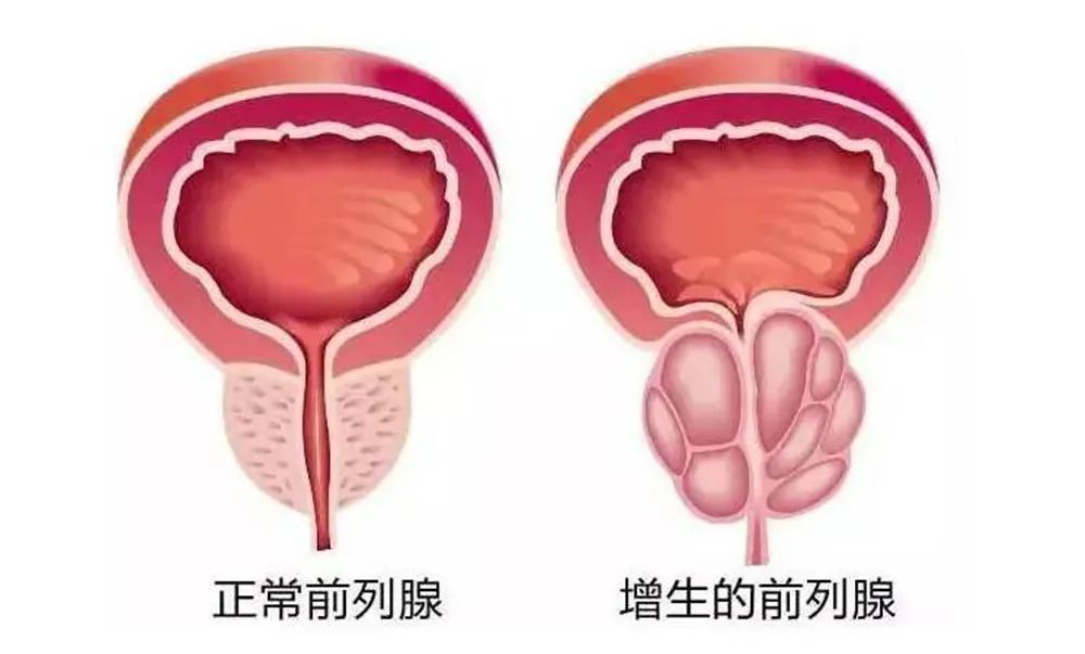 四川瑞梦热蒸汽消融术：3分钟解决长达七年之久的前列腺增生问题(图1)