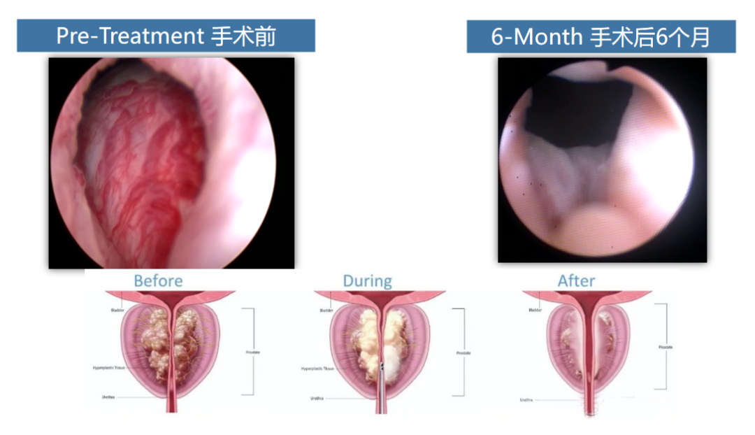 四川瑞梦热蒸汽消融术适用人群及优势分析，快来了解一下！(图3)