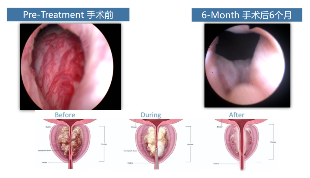 四川瑞梦热蒸汽消融术:前列腺增生治疗新技术!(图1) 四川瑞梦热蒸汽消融术:前列腺增生治疗新技术!(图1)