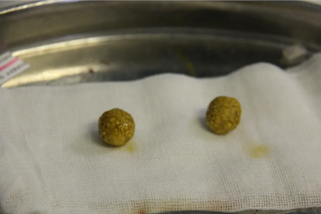 四川j结石病医院科普: 又到“胆结石高发季”!患者该怎么办?(图2) 四川j结石病医院科普: 又到“胆结石高发季”!患者该怎么办?(图2)