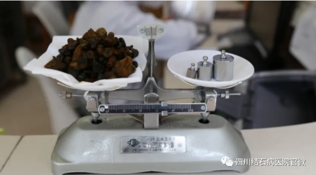 胆结石拖一拖无所谓?四川胆结石专家提醒及时就医!(图3) 胆结石拖一拖无所谓?四川胆结石专家提醒及时就医!(图3)