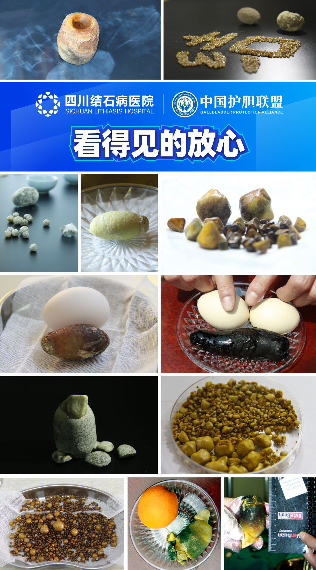 胆结石拖一拖无所谓?四川胆结石专家提醒及时就医!(图6) 胆结石拖一拖无所谓?四川胆结石专家提醒及时就医!(图6)