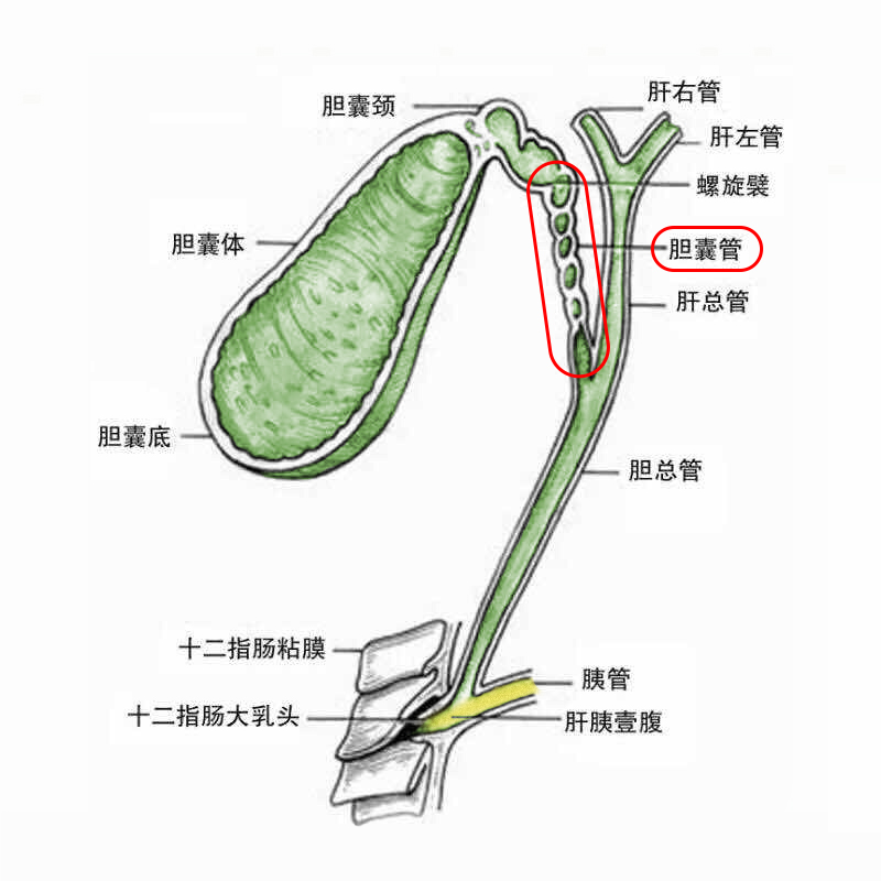 胆囊切除了,是不是就不会再长结石了?关于胆囊结石的真相在这里(图2) 胆囊切除了,是不是就不会再长结石了?关于胆囊结石的真相在这里(图2)
