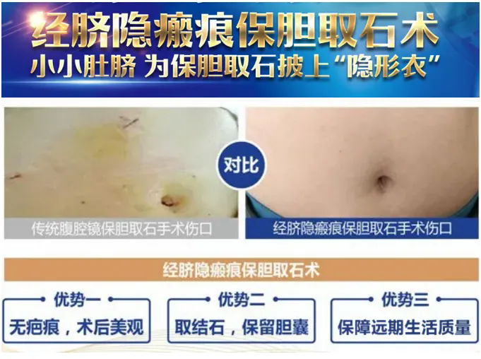 害怕手术、想吃药的胆结石病友,来看看这个患者的亲身经历「成都胆结石医院」(图5) 害怕手术、想吃药的胆结石病友,来看看这个患者的亲身经历「成都胆结石医院」(图5)