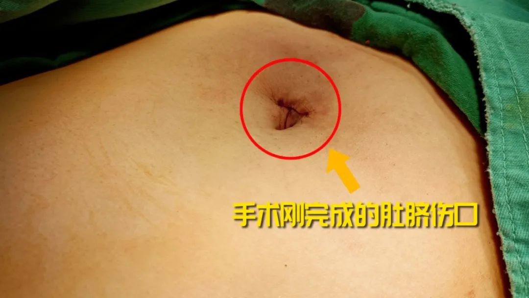 探访直击:四川结石病医院“隐形保胆”技术!「全国保胆取石基地」(图1) 探访直击:四川结石病医院“隐形保胆”技术!「全国保胆取石基地」(图1)