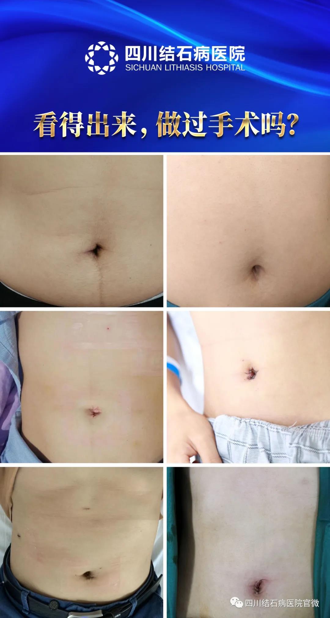 硬实力!四川结石病医院领跑隐痕保胆技术,保胆取石+疤痕隐形!(图1) 硬实力!四川结石病医院领跑隐痕保胆技术,保胆取石+疤痕隐形!(图1)