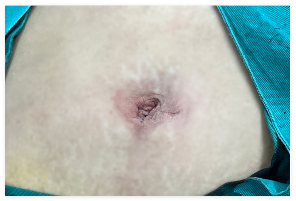 对话保胆者:你们的技术太牛了!伤口根本看不出来!【四川保胆取石医院】(图1) 对话保胆者:你们的技术太牛了!伤口根本看不出来!【四川保胆取石医院】(图1)