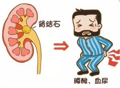 警惕!肾结石平时没啥感觉,一查发现竟充满整个肾脏!【成都结石病医院 | 成都肾结石医院】(图2) 警惕!肾结石平时没啥感觉,一查发现竟充满整个肾脏!【成都结石病医院 | 成都肾结石医院】(图2)