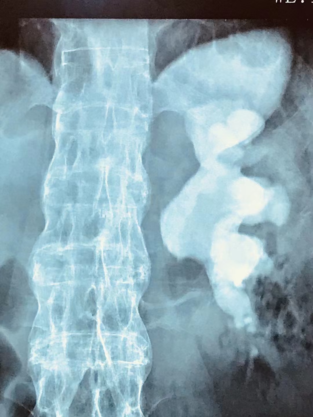 警惕!肾结石平时没啥感觉,一查发现竟充满整个肾脏!【成都结石病医院 | 成都肾结石医院】(图5) 警惕!肾结石平时没啥感觉,一查发现竟充满整个肾脏!【成都结石病医院 | 成都肾结石医院】(图5)