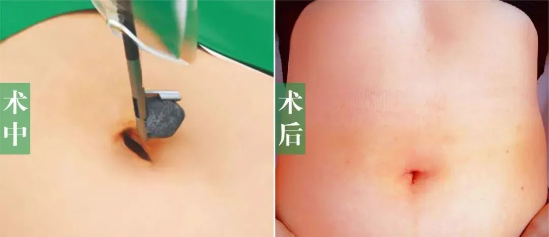 伤口还能这么隐形?聚焦超微创经脐隐瘢痕保胆取石手术【四川胆结石医院】(图3) 伤口还能这么隐形?聚焦超微创经脐隐瘢痕保胆取石手术【四川胆结石医院】(图3)