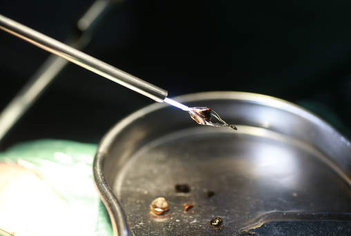 22岁小伙的肾已布满结石!四川结石病医院专家:这些行为正在掏空年轻人(图2) 22岁小伙的肾已布满结石!四川结石病医院专家:这些行为正在掏空年轻人(图2)