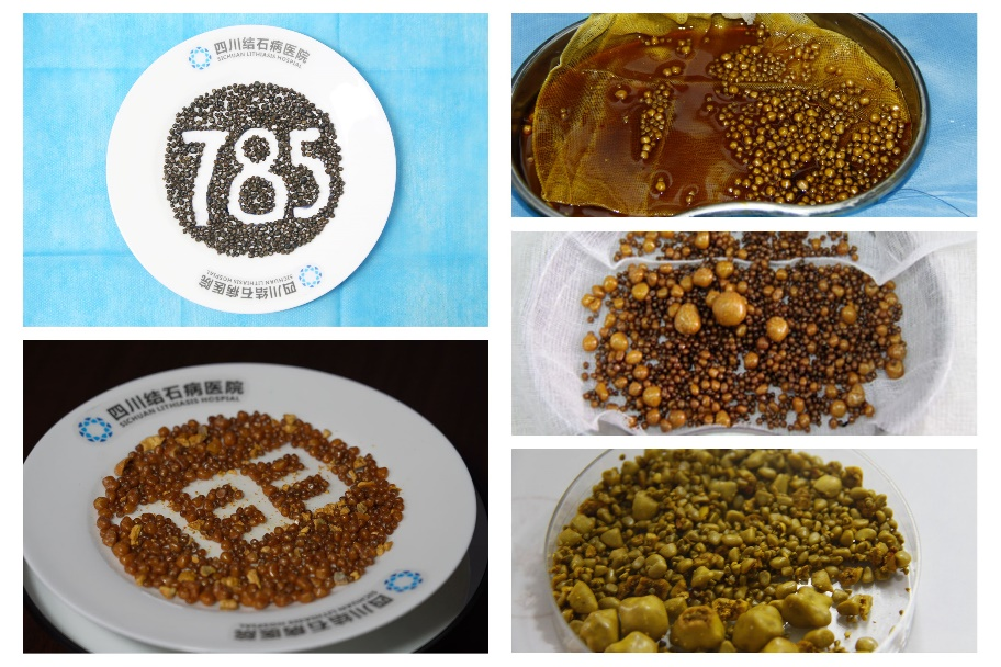 四川眉山女子毫无感觉,胆囊里竟疯长出108颗“好汉结石”【四川保胆取石最好的医院排名】(图5) 四川眉山女子毫无感觉,胆囊里竟疯长出108颗“好汉结石”【四川保胆取石最好的医院排名】(图5)