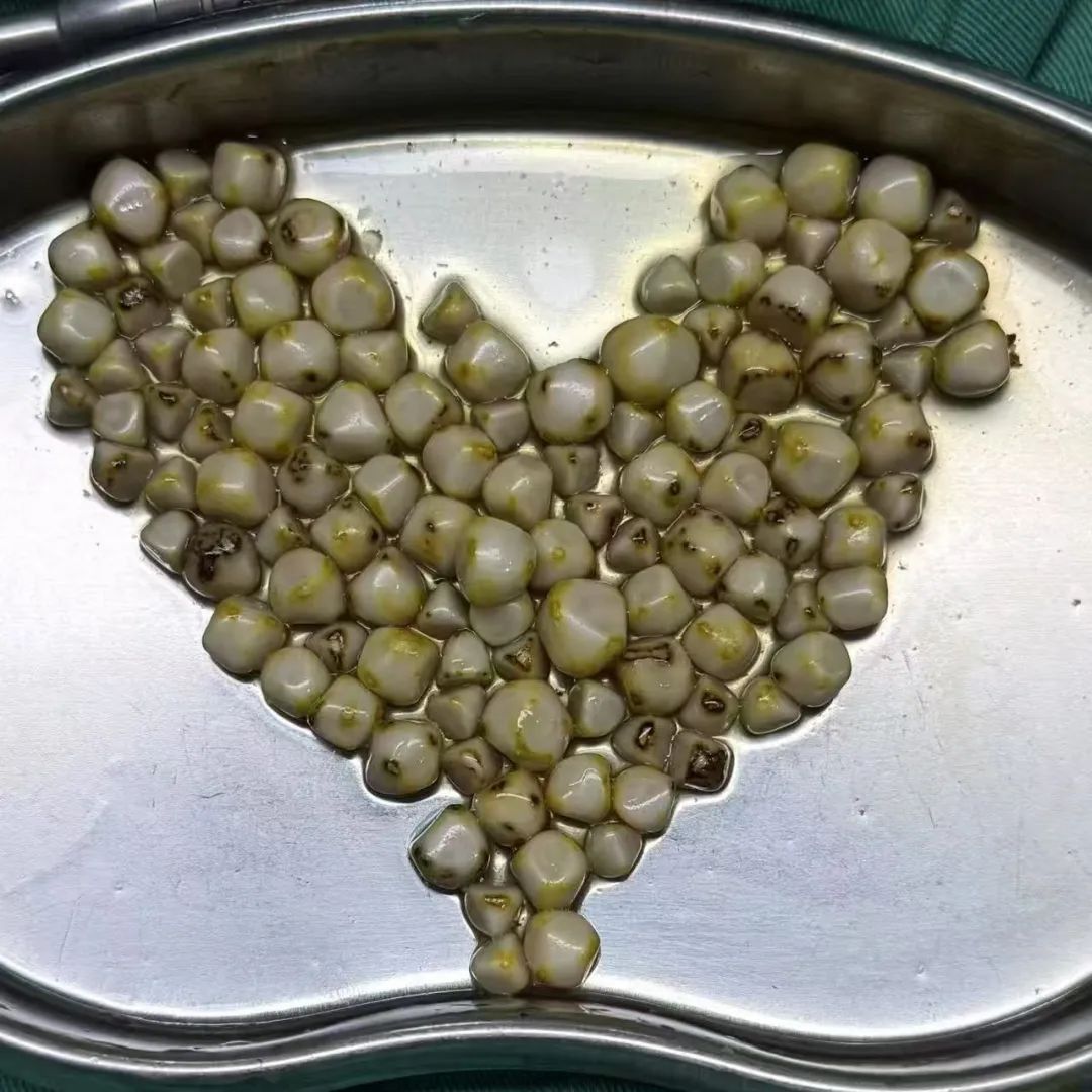 四川眉山女子毫无感觉,胆囊里竟疯长出108颗“好汉结石”【四川保胆取石最好的医院排名】(图1) 四川眉山女子毫无感觉,胆囊里竟疯长出108颗“好汉结石”【四川保胆取石最好的医院排名】(图1)