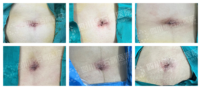 跨越九年的保胆路：一对夫妻见证从「微创」到「超微创隐形」的技术进步(图4)