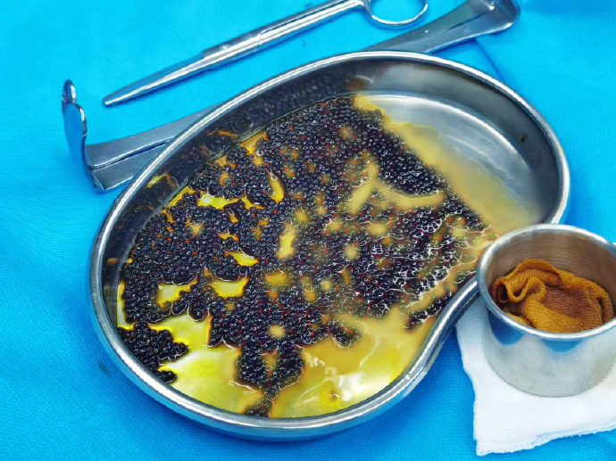 小石子，大隐患！专家提醒您：警惕胆道里的“不速之客”【成都胆结石治疗医院】(图2)