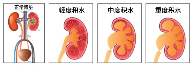 为什么建议肾积水患者要尽快手术治疗？四川结石病医院专家解析时间的重要性！(图2)