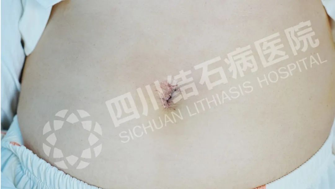 幼儿园大厨的“脐”遇:圆梦保胆,不留手术痕迹【四川保胆取石案例】(图1) 幼儿园大厨的“脐”遇:圆梦保胆,不留手术痕迹【四川保胆取石案例】(图1)