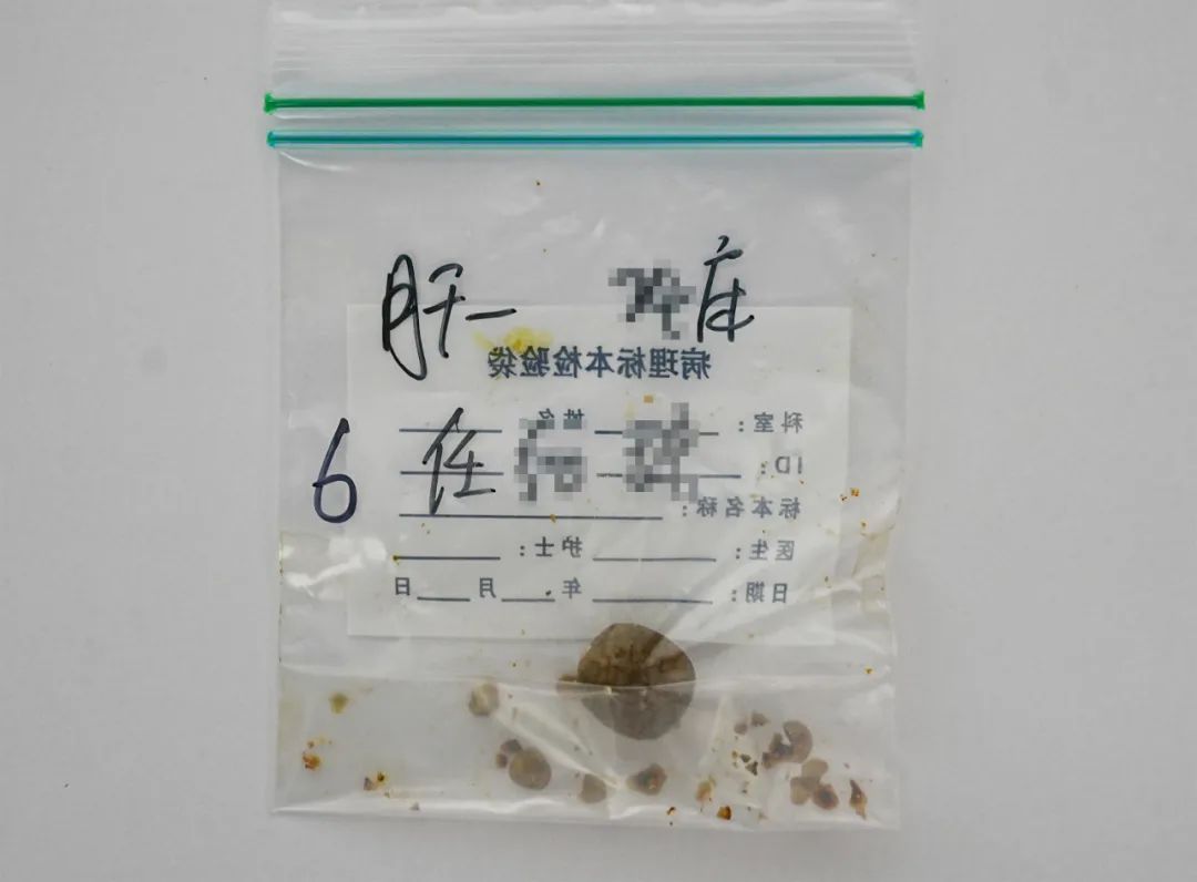 幼儿园大厨的“脐”遇:圆梦保胆,不留手术痕迹【四川保胆取石案例】(图2) 幼儿园大厨的“脐”遇:圆梦保胆,不留手术痕迹【四川保胆取石案例】(图2)