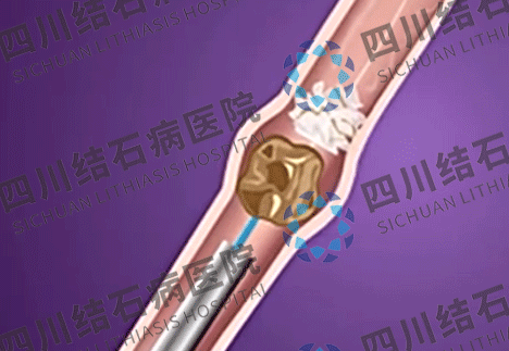 身体出现这4个症状，是肾脏的求救信号【四川肾结石专科医院】(图4)