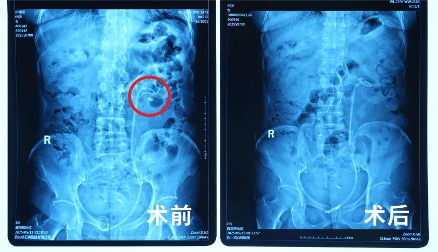 三战结石!当地医生摇头放弃,这家医院却为她卸下“石”压重负【四川结石病医院】】(图2) 三战结石!当地医生摇头放弃,这家医院却为她卸下“石”压重负【四川结石病医院】】(图2)
