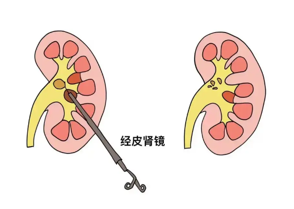 患者关注:肾结石术后多久能恢复?从手术区别到恢复周期,一篇讲明白!【四川结石病专科医院】(图3) 患者关注:肾结石术后多久能恢复?从手术区别到恢复周期,一篇讲明白!【四川结石病专科医院】(图3)