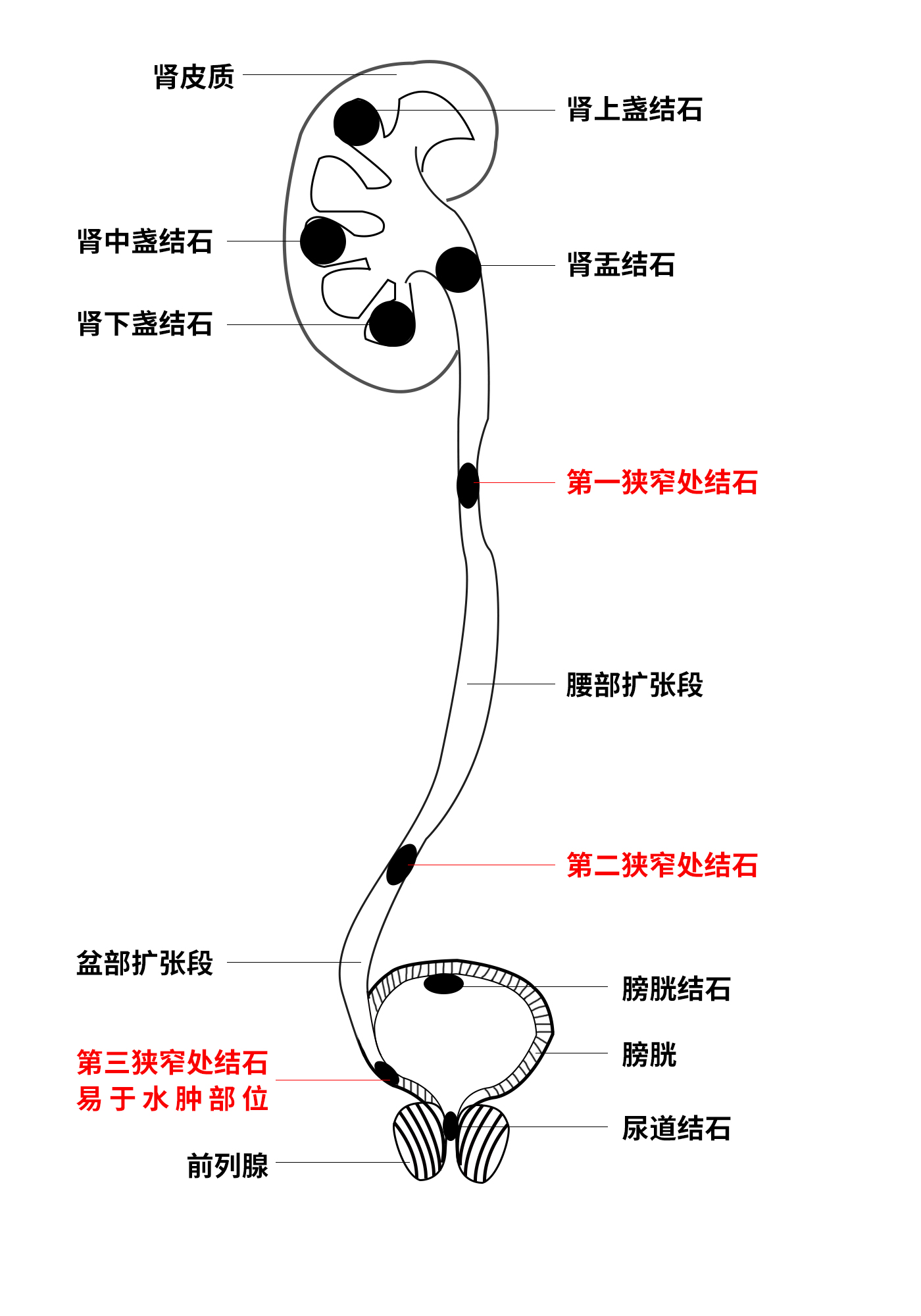输尿管结石与狭窄:藏在体内的“恶性循环”,背后关系大揭秘!(图3) 输尿管结石与狭窄:藏在体内的“恶性循环”,背后关系大揭秘!(图3)