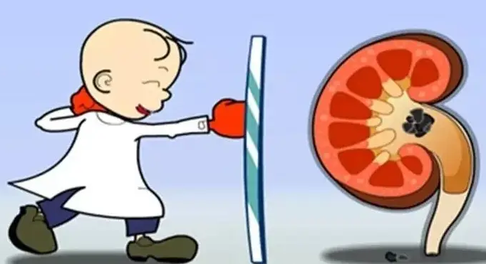 肾结石治疗:体外碎石和手术取石怎么选?专家一次性说清楚【成都肾结石治疗医院】(图4) 肾结石治疗:体外碎石和手术取石怎么选?专家一次性说清楚【成都肾结石治疗医院】(图4)