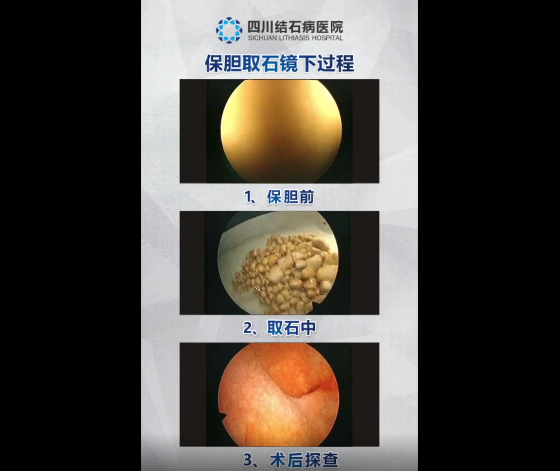 胆囊健康科普宣传周:犹豫“切胆”还是“保胆”?看完就不纠结了!【成都保胆取石医院】(图4) 胆囊健康科普宣传周:犹豫“切胆”还是“保胆”?看完就不纠结了!【成都保胆取石医院】(图4)