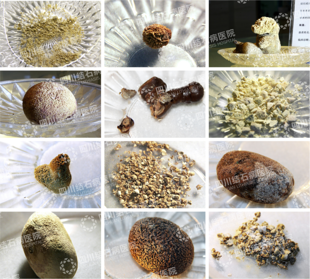 肾结石快速排出指南:科学方法助力结石排出【成都24小时碎石医院】(图7) 肾结石快速排出指南:科学方法助力结石排出【成都24小时碎石医院】(图7)