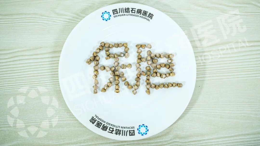 四川保胆案例分享：七年无感却藏126颗结石！男子胆囊惊现“珍珠串”(图2)