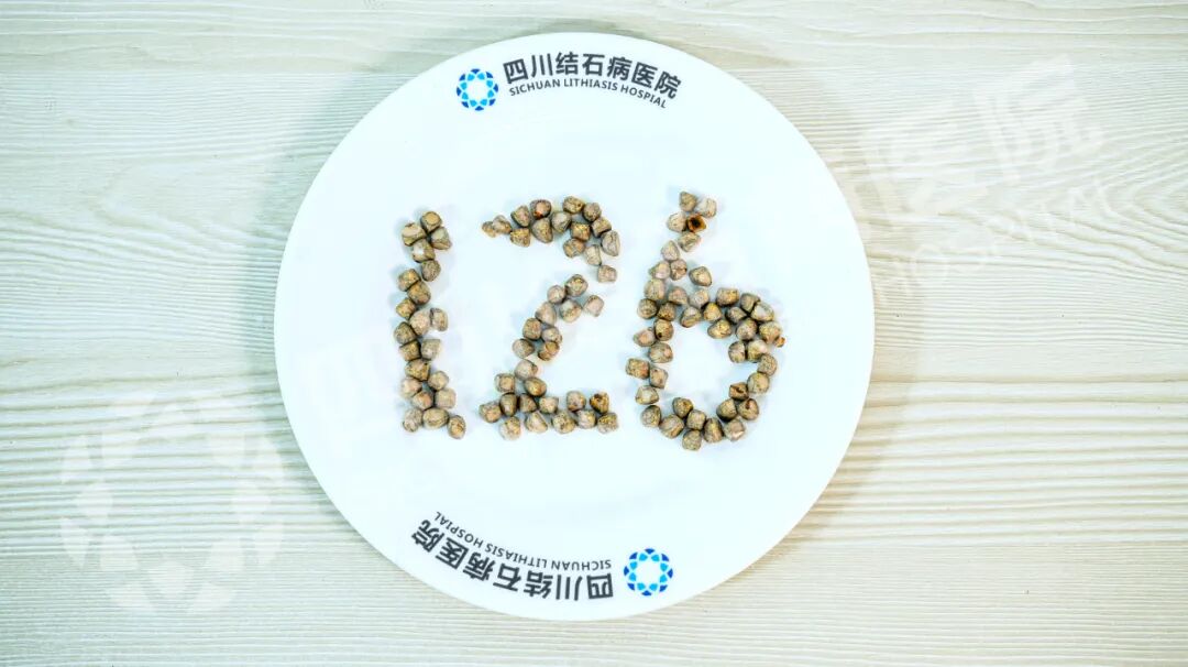 四川保胆案例分享：七年无感却藏126颗结石！男子胆囊惊现“珍珠串”(图5)
