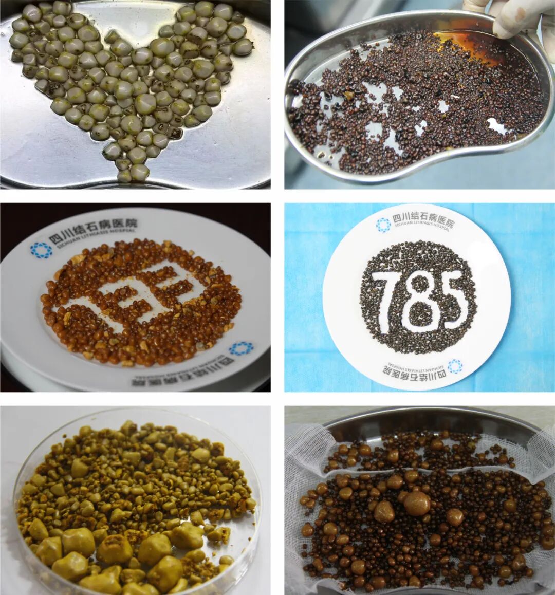 四川保胆案例分享:七年无感却藏126颗结石!男子胆囊惊现“珍珠串”(图6) 四川保胆案例分享:七年无感却藏126颗结石!男子胆囊惊现“珍珠串”(图6)