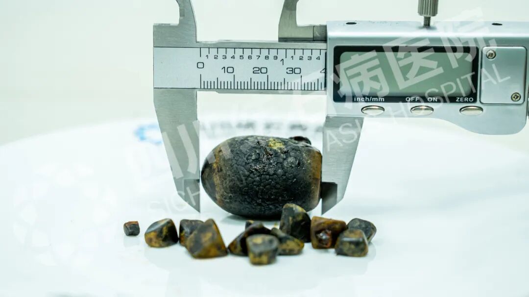 胆囊内取出“黑色军团”：最大结石4厘米，六类人要注意！【四川胆结石专科医院】(图1)