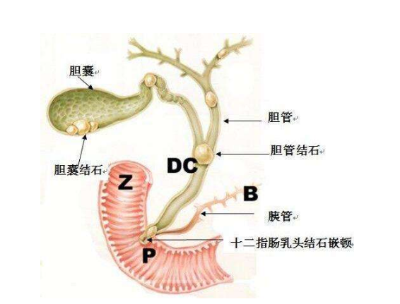 胆囊长息肉、结石了？别慌！医生详解 “鸭梨形” 胆囊：这些大作用，守护你的健康（建议收藏）(图2)