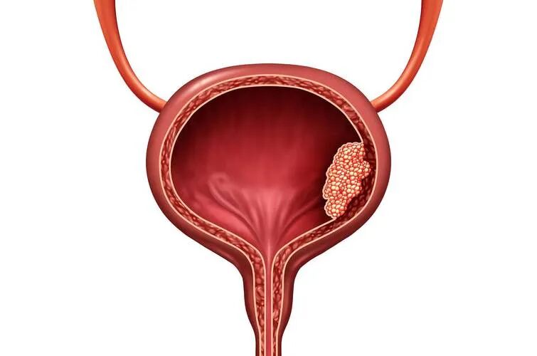 身体在报警！排尿异常背后的“真凶”，可能是膀胱结石【四川结石病专科医院】(图8)