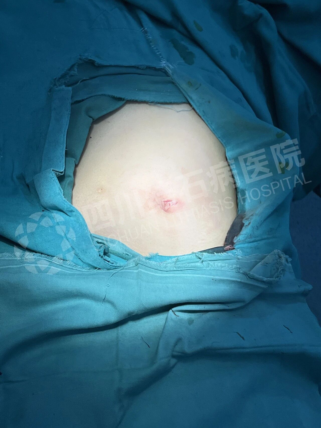 怕留疤？怕切胆？经脐隐瘢痕技术实现“鱼与熊掌兼得”【四川结石病医院】(图3)