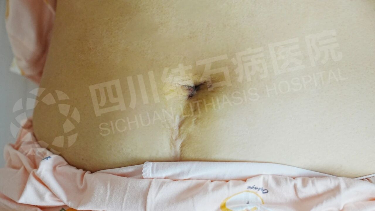 怕留疤？怕切胆？经脐隐瘢痕技术实现“鱼与熊掌兼得”【四川结石病医院】(图6)