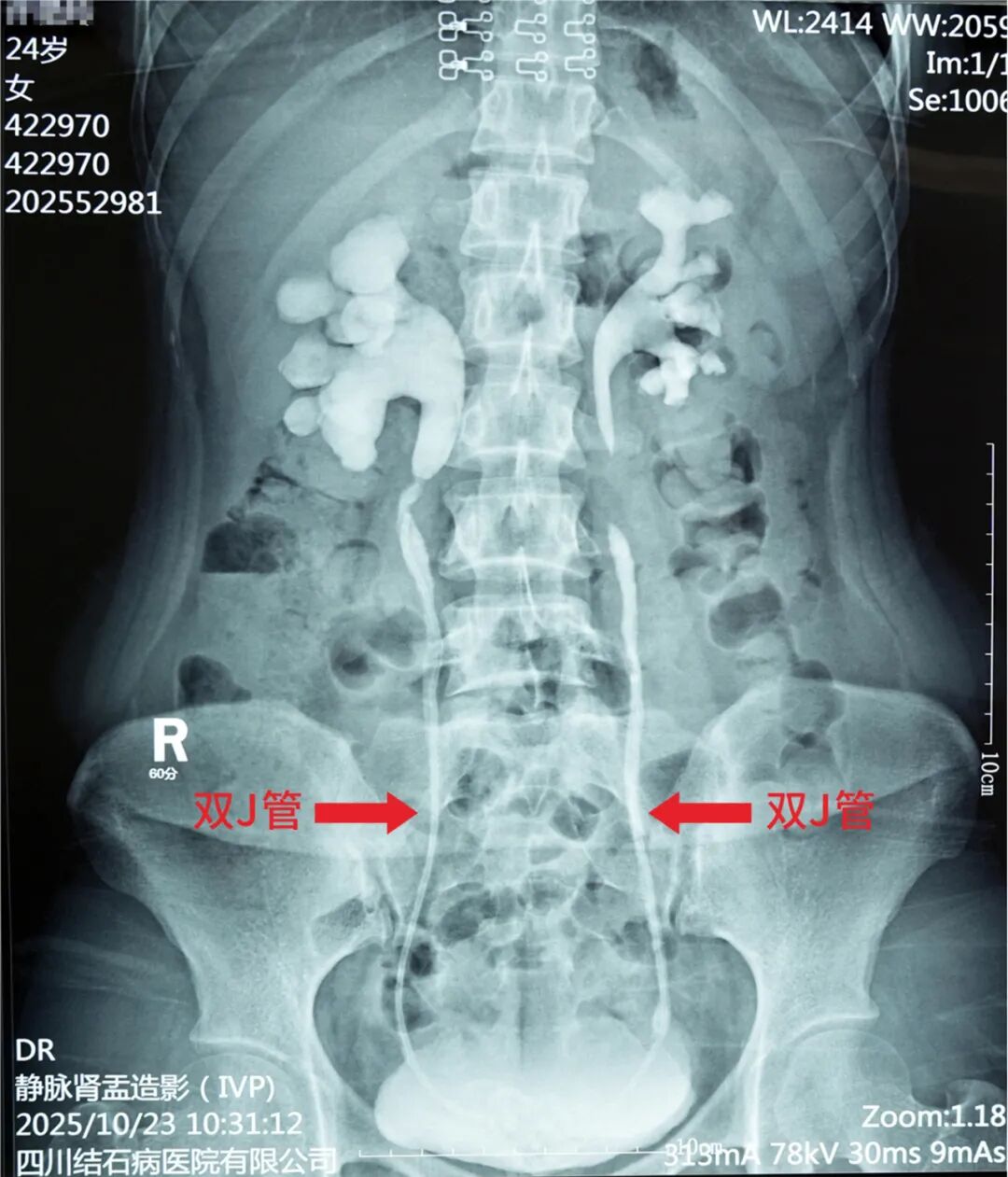 24岁女子双肾功能受损！原因竟是她将这个忘在了身体里……【四川结石病医院】(图1)