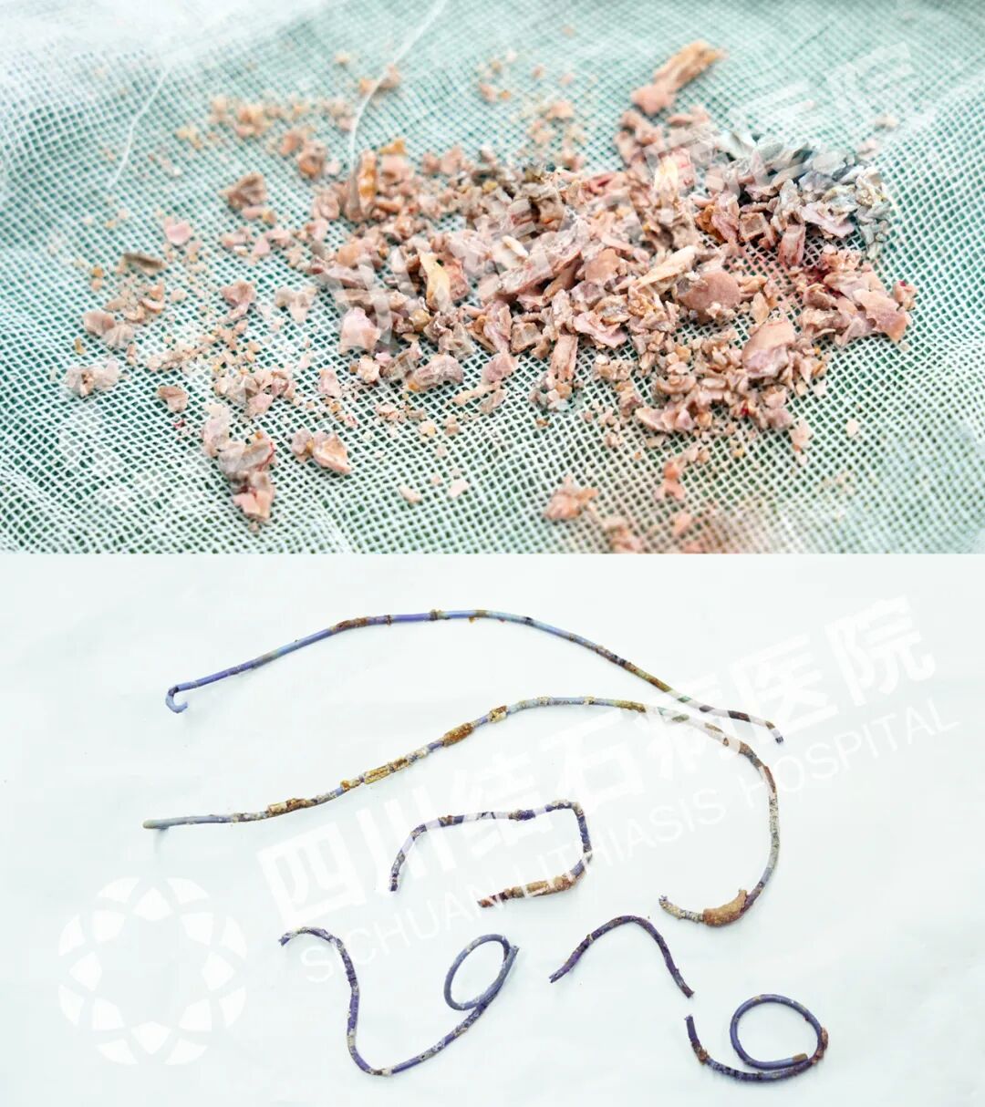 24岁女子双肾功能受损！原因竟是她将这个忘在了身体里……【四川结石病医院】(图4)