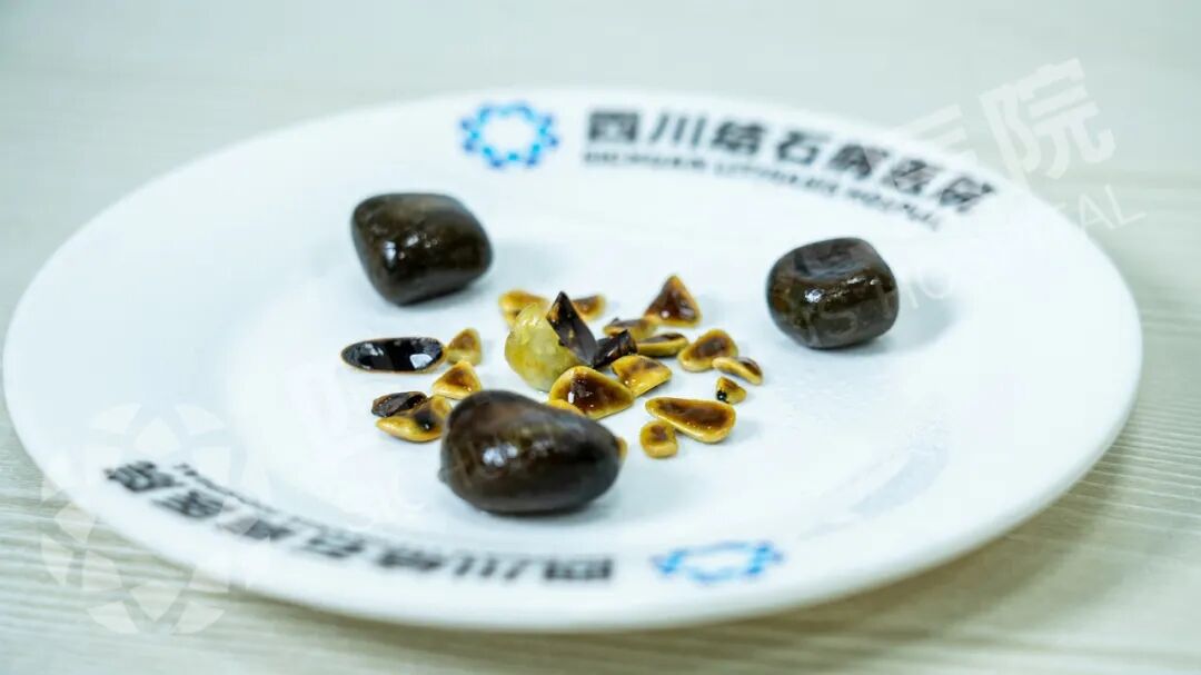 26颗胆结石形如板栗松子 医生提醒：和这些原因密切相关(图1)