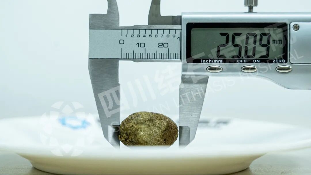 奔波求医路：广元大姐专程来蓉保胆，取出“皮蛋”状结石【四川保胆取石医院】(图1)