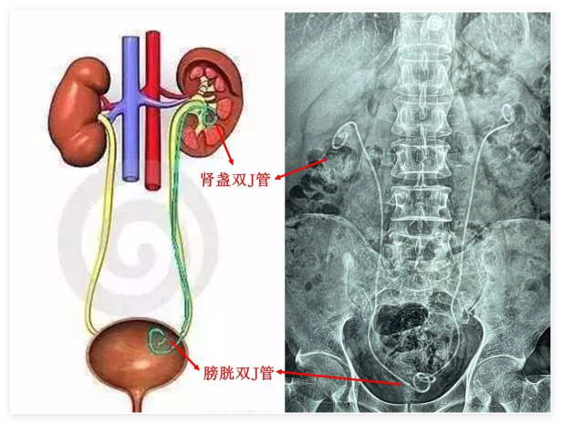 患者点赞无管化手术：微创取石，更快回归健康生活【四川泌尿结石治疗医院】(图5)
