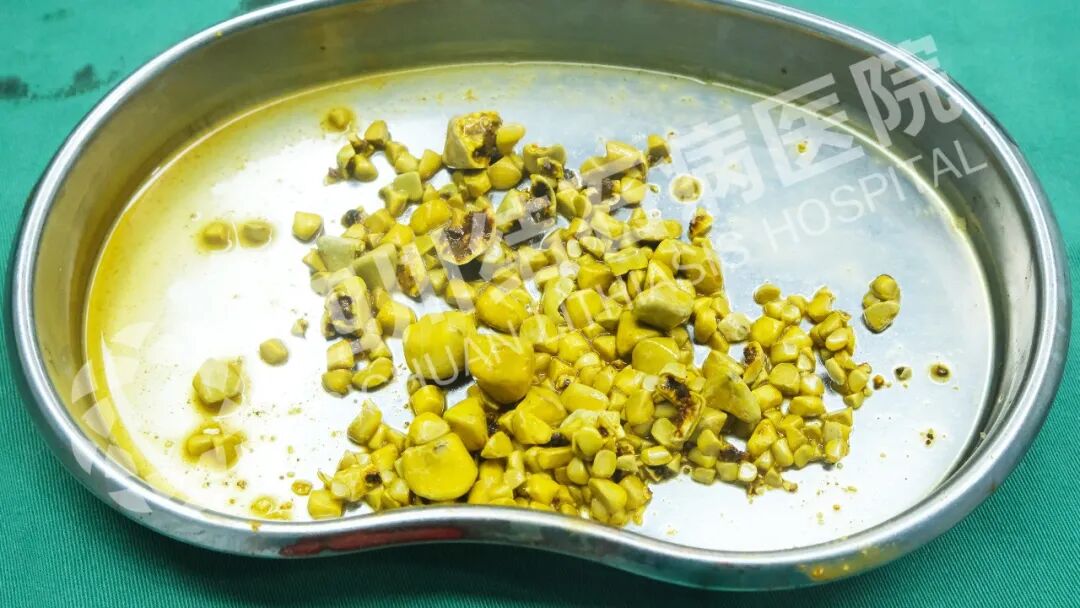 【媒体报道】四川结石病医院保胆取出430颗结石！专家支招，健康过年(图4)