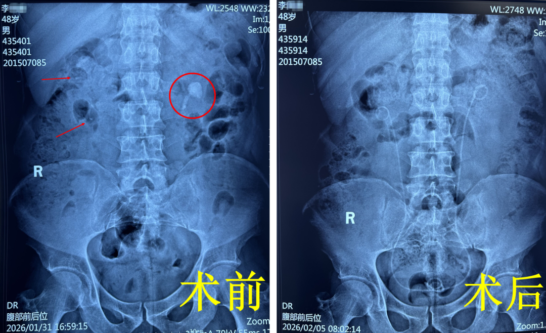 “常年立信高一刀”：春节前的特殊锦旗【四川肾结石专科医院】(图4)